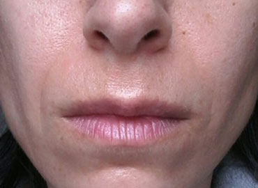 Before/Afters Face Yoga Transformations That All Of Us Wish For