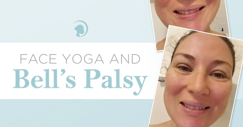 Bell's palsy patient's progress with Face Yoga.