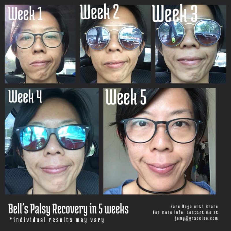 Patient with Bell's Palsy and her progress by doing facial exercises. 