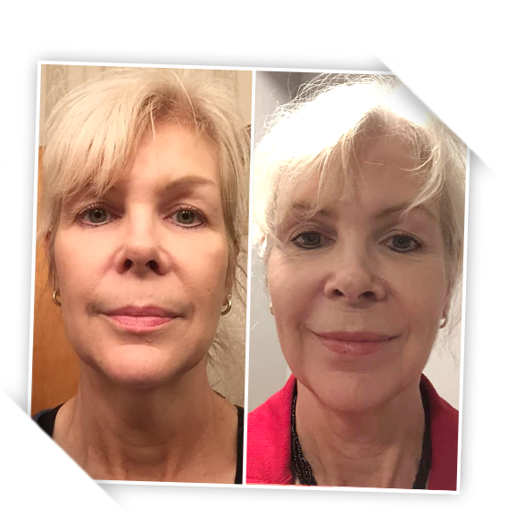 Two photos of a woman smiling - comparison at different age stages.