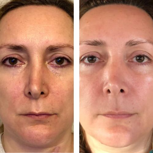 Woman's face before and after face yoga