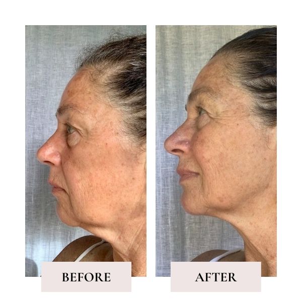 Before and after face yoga - comparison of Barbara's face. 