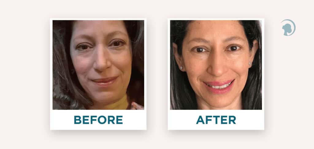 Before and after face yoga - comparison of Gloria's face. 