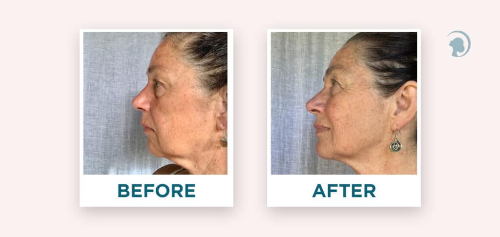 Before and after face yoga - comparison of a woman's face. 