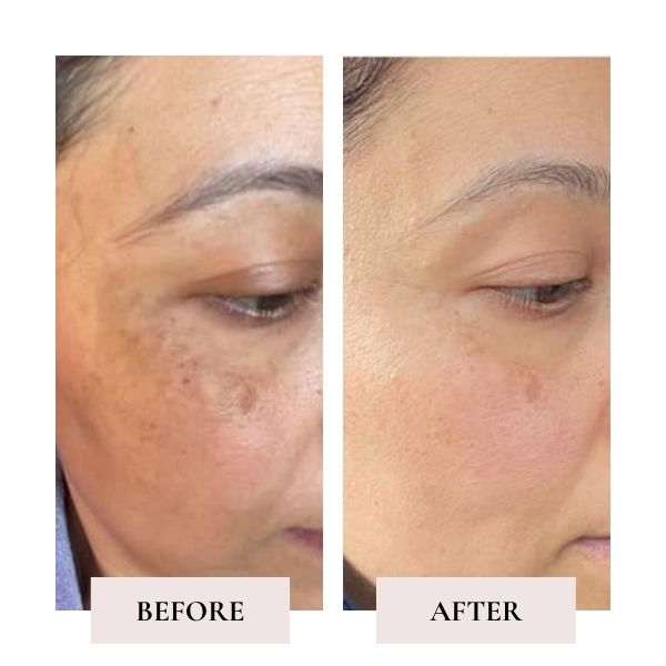 Before and after face yoga - comparison of Sandhya's face. 