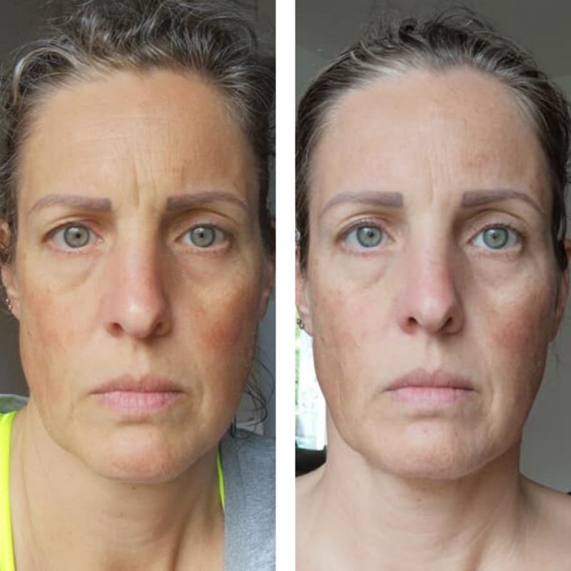 Eyes and Forehead wrinkles - Before and After Face Yoga Result