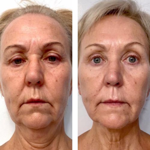 glabellar lines before and after face yoga — Face Yoga Method