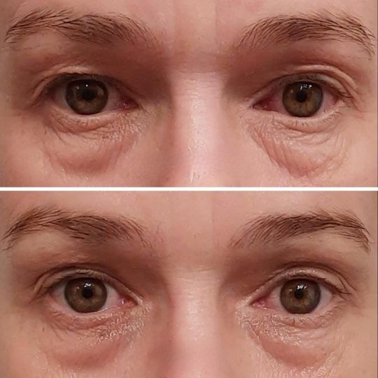 Woman's eyes before and after face yoga practice