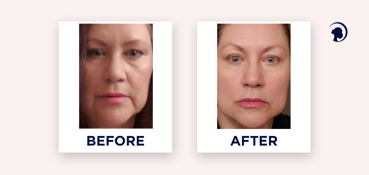 Sagging jowls reduction with Face Yoga. 