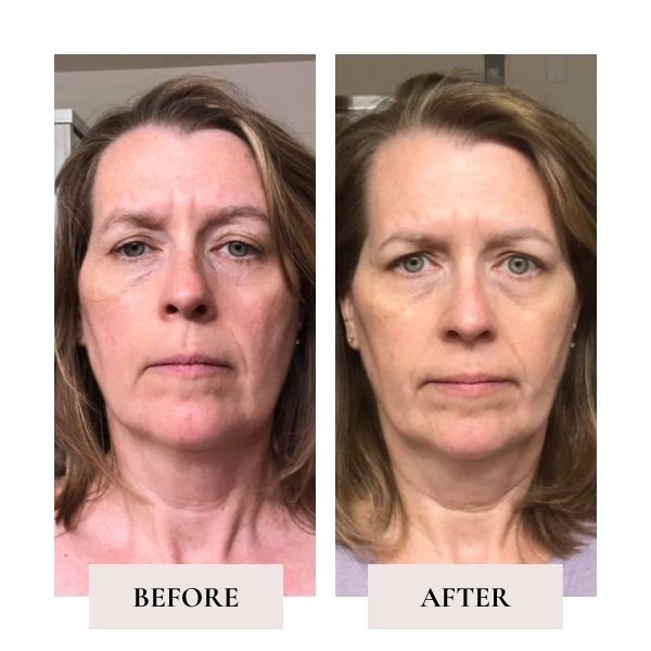 face yoga for frown lines before and after — Face Yoga Method